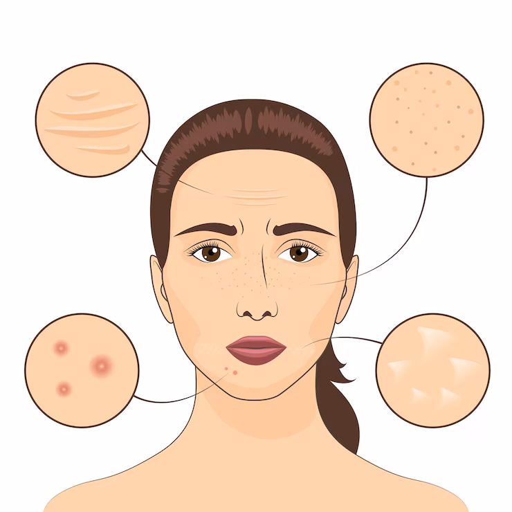 Acne Solutions in Noida with Dr. Rachna Singh